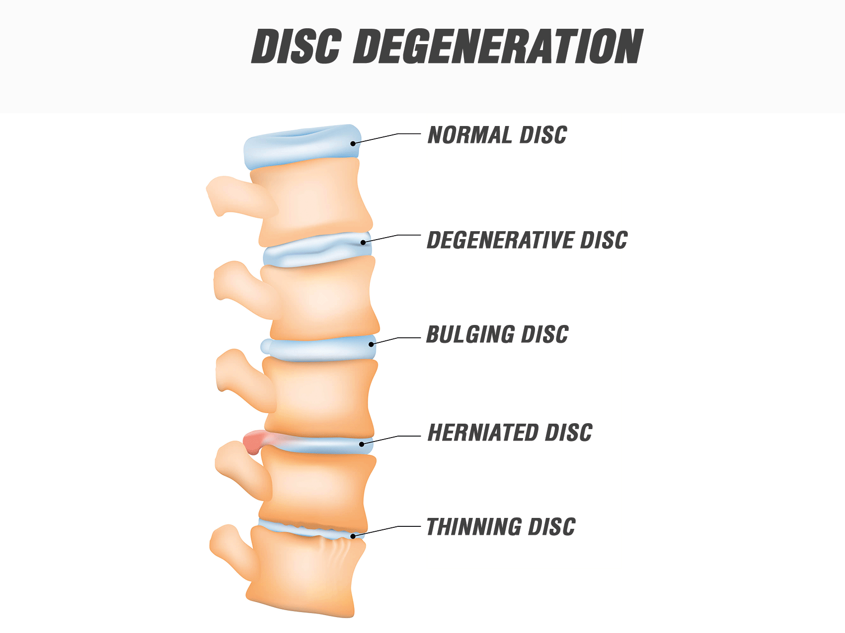 Dischi Intervertebrali